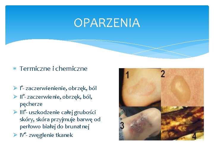 OPARZENIA Termiczne i chemiczne Ø I°- zaczerwienienie, obrzęk, ból Ø II°- zaczerwienie, obrzęk, ból,