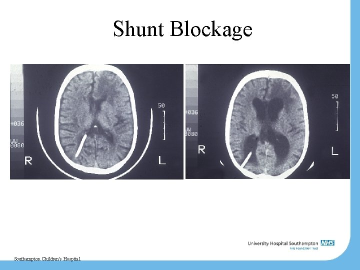 Shunt Blockage Southampton Children's Hospital 