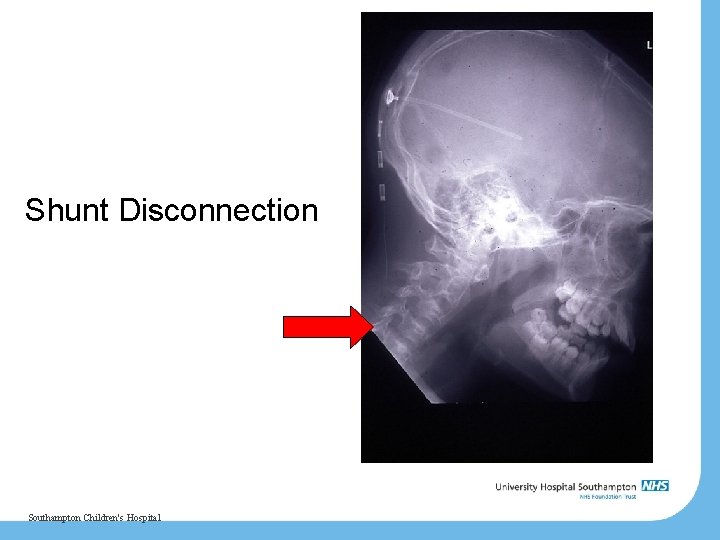 Shunt Disconnection Southampton Children's Hospital 