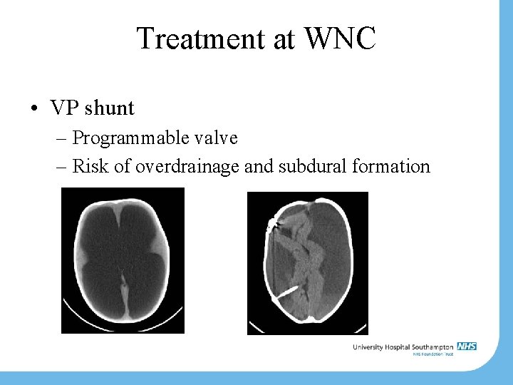 Treatment at WNC • VP shunt – Programmable valve – Risk of overdrainage and