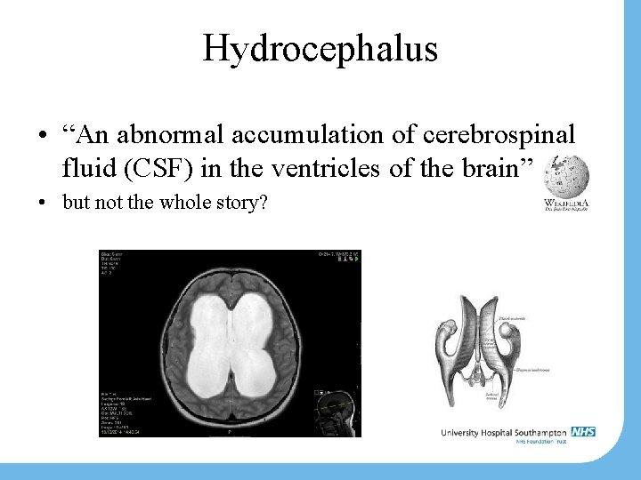 Hydrocephalus • “An abnormal accumulation of cerebrospinal fluid (CSF) in the ventricles of the