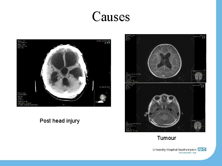 Causes Post head injury Tumour 