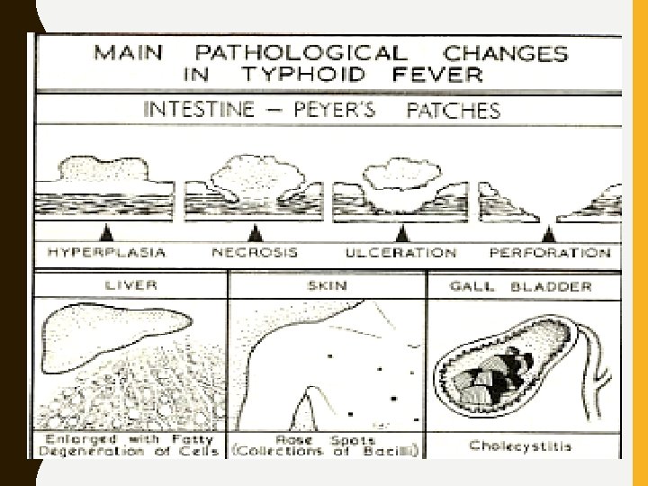  • Pathogenic Mechanism Invasion, translocation, lymphoid inflammation and dissemination • Typhoid ulcers are