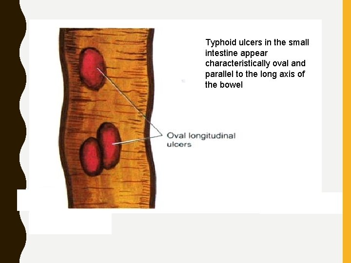 Typhoid ulcers in the small intestine appear characteristically oval and parallel to the long