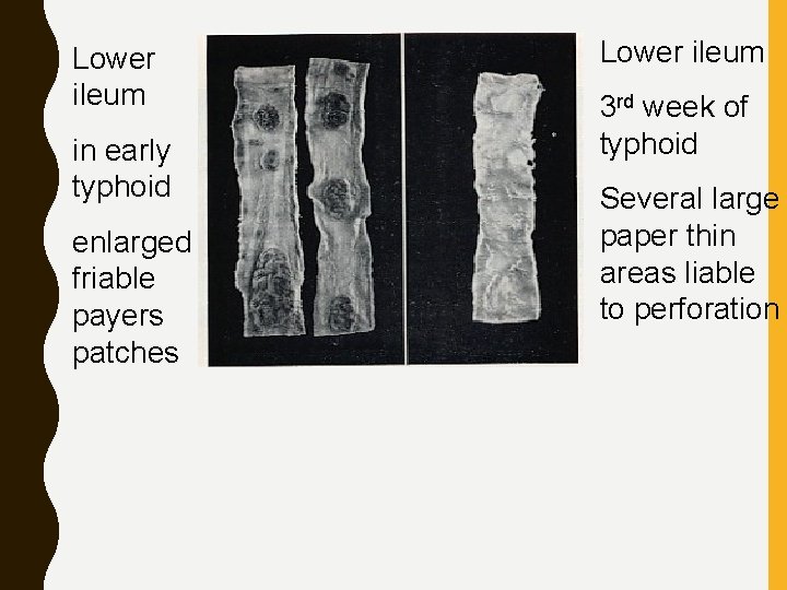 Lower ileum in early typhoid enlarged friable payers patches Lower ileum 3 rd week