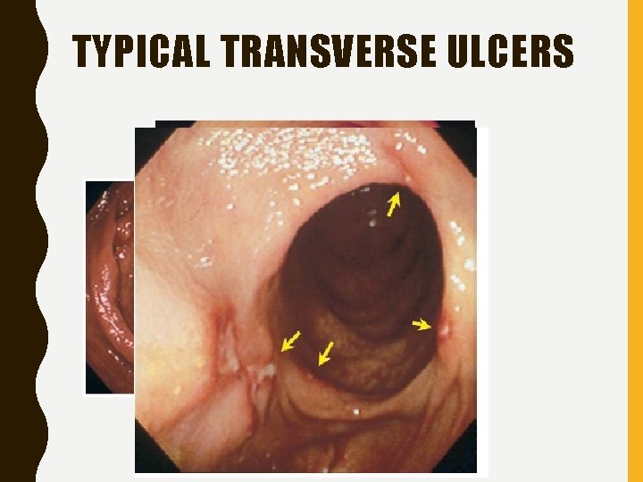 TYPICAL TRANSVERSE ULCERS 