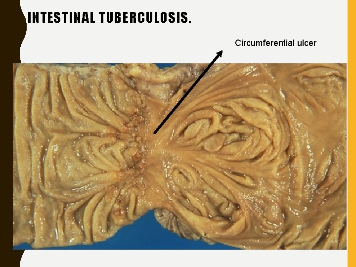 INTESTINAL TUBERCULOSIS. 　　 Circumferential ulcer 