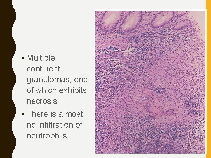  • Multiple confluent granulomas, one of which exhibits necrosis. • There is almost