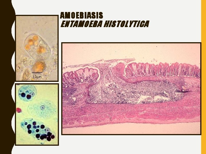 AMOEBIASIS ENTAMOEBA HISTOLYTICA 