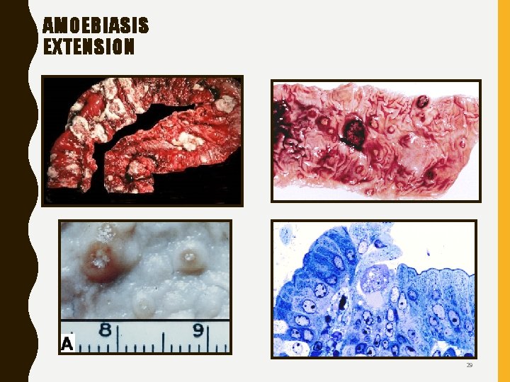 AMOEBIASIS EXTENSION 29 