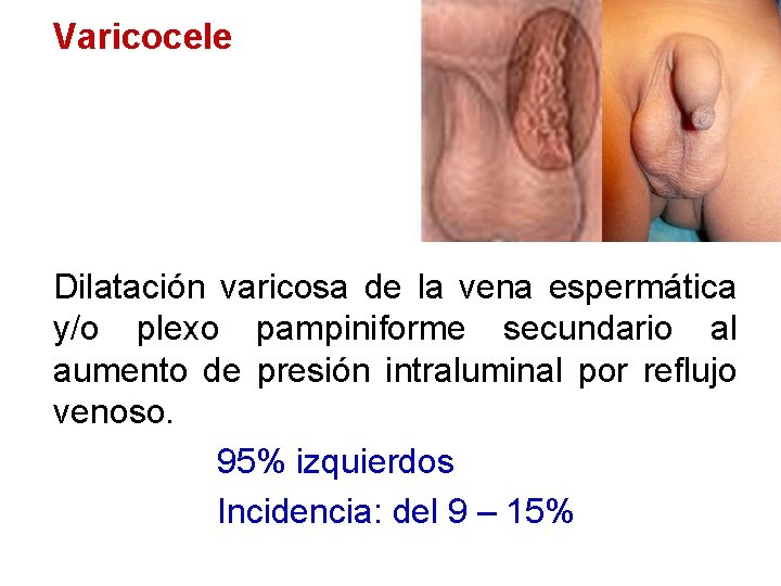 Varicocele Dilatación varicosa de la vena espermática y/o plexo pampiniforme secundario al aumento de