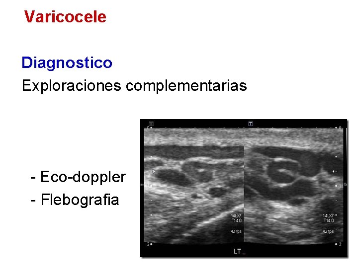 Varicocele Diagnostico Exploraciones complementarias - Eco-doppler - Flebografia 