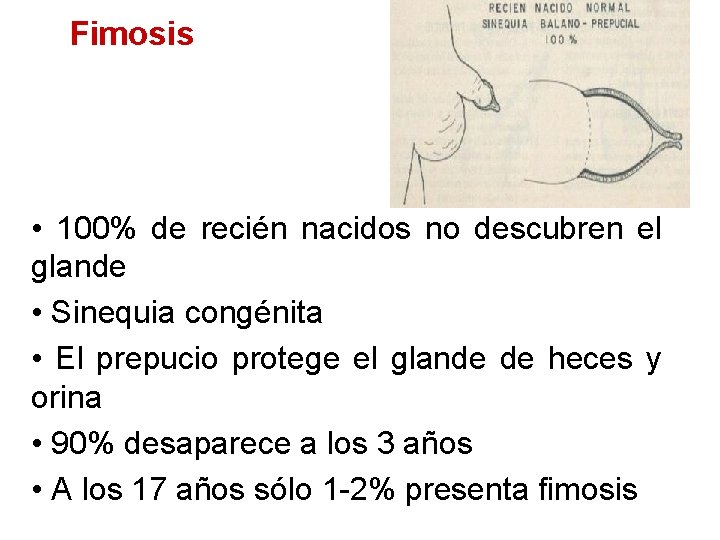 Fimosis • 100% de recién nacidos no descubren el glande • Sinequia congénita •