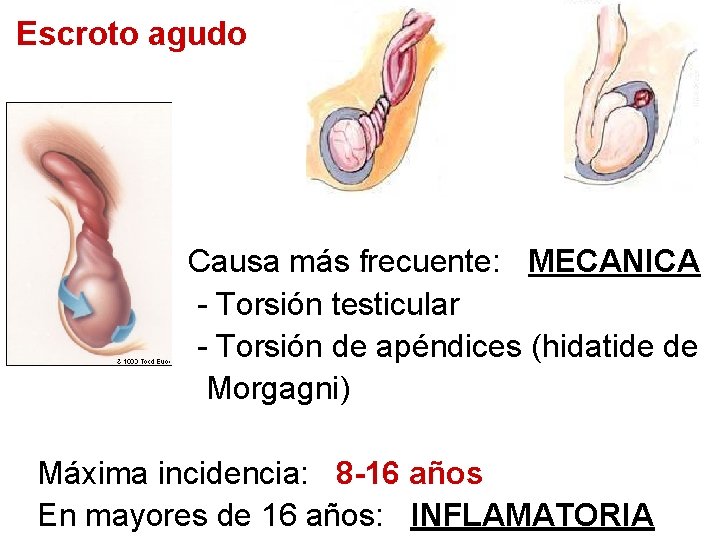 Escroto agudo Causa más frecuente: MECANICA - Torsión testicular - Torsión de apéndices (hidatide