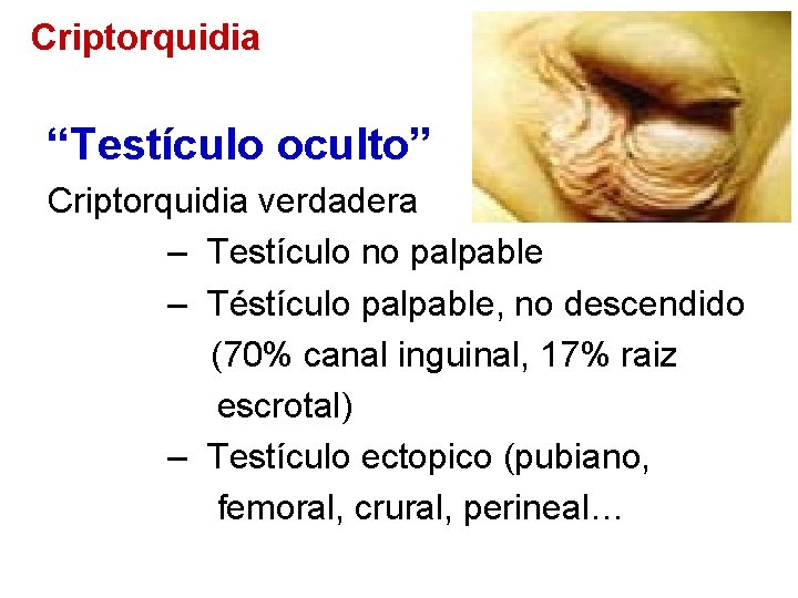 Criptorquidia “Testículo oculto” Criptorquidia verdadera – Testículo no palpable – Téstículo palpable, no descendido