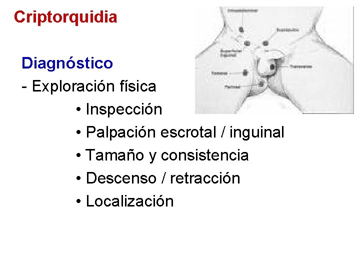 Criptorquidia Diagnóstico - Exploración física • Inspección • Palpación escrotal / inguinal • Tamaño