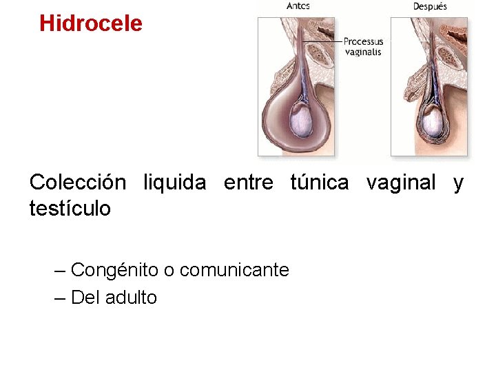 Hidrocele Colección liquida entre túnica vaginal y testículo – Congénito o comunicante – Del