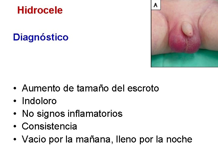 Hidrocele Diagnóstico • • • Aumento de tamaño del escroto Indoloro No signos inflamatorios