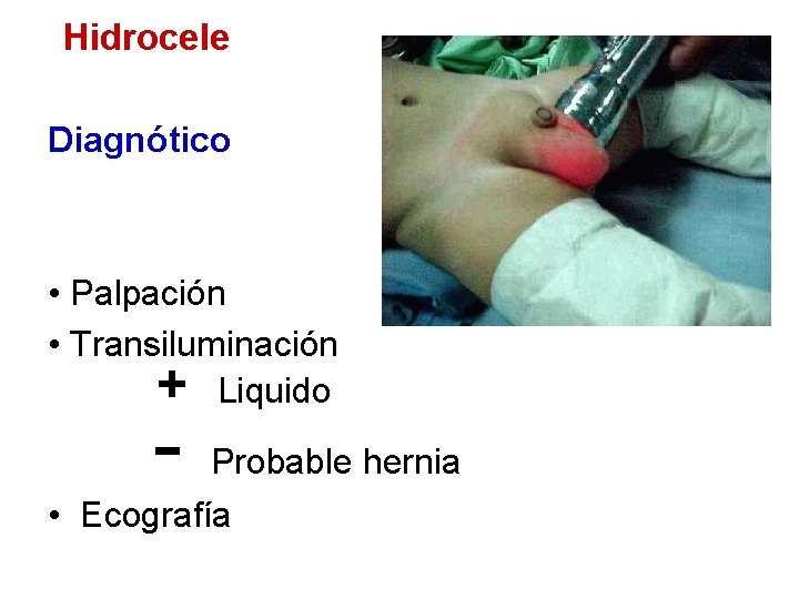 Hidrocele Diagnótico • Palpación • Transiluminación + Liquido - Probable hernia • Ecografía 
