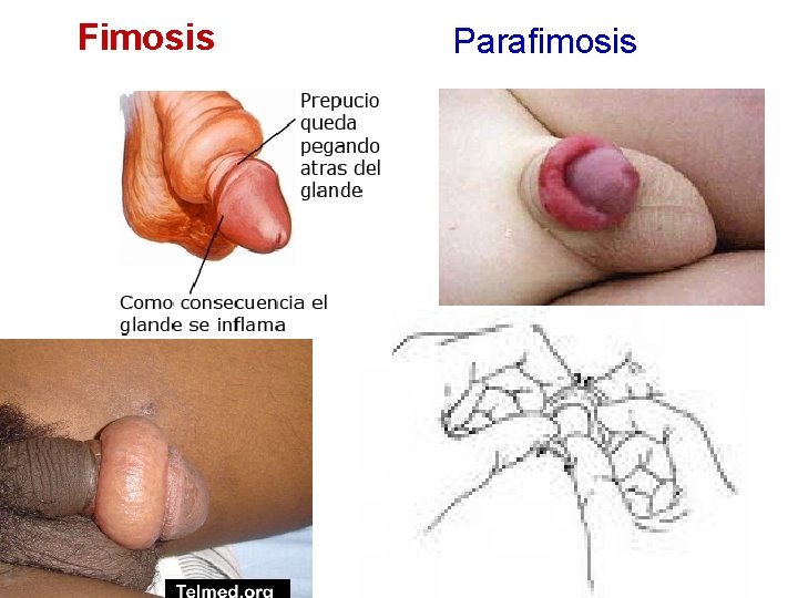 Fimosis Parafimosis 