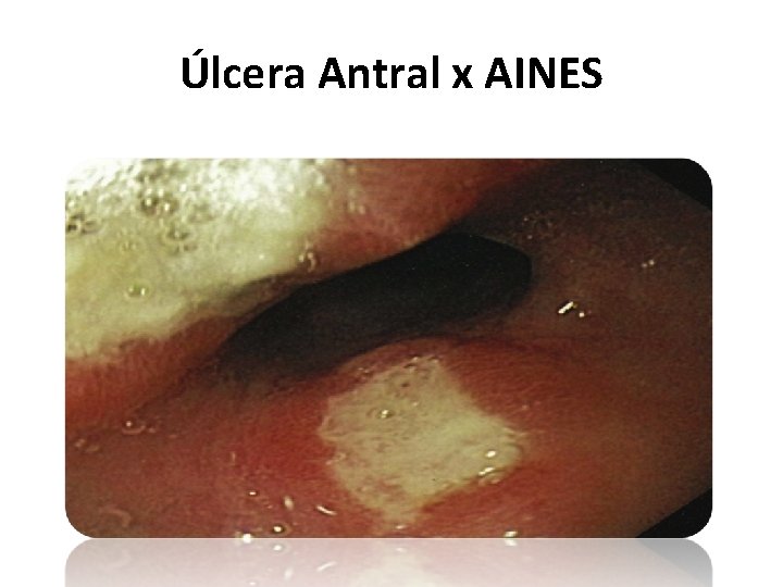 Úlcera Antral x AINES 