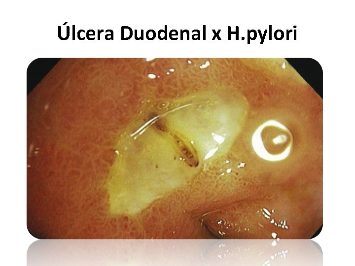 Úlcera Duodenal x H. pylori 