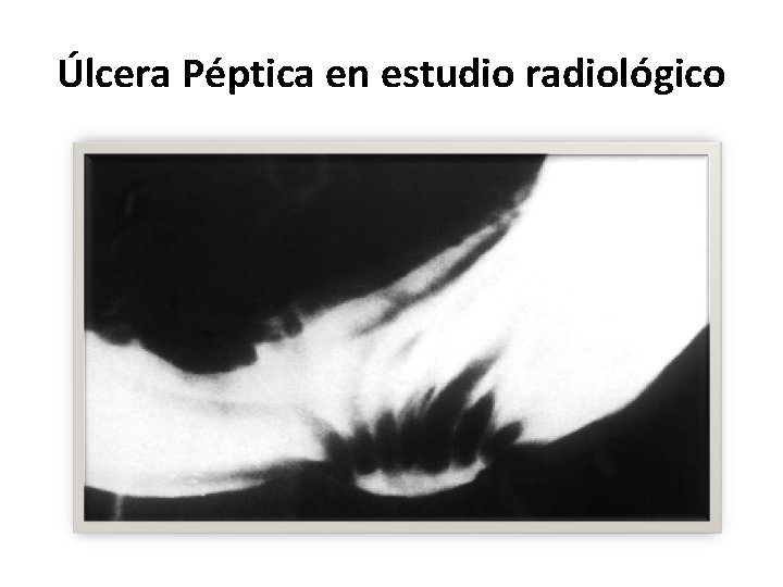 Úlcera Péptica en estudio radiológico 