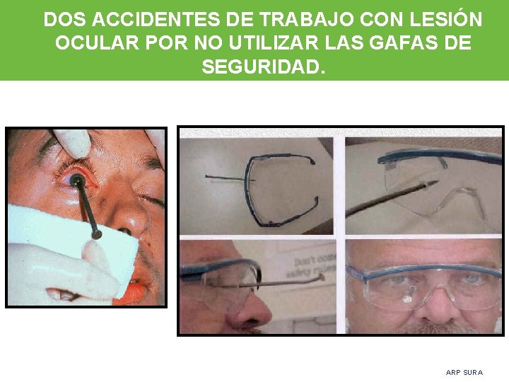 DOS ACCIDENTES DE TRABAJO CON LESIÓN OCULAR POR NO UTILIZAR LAS GAFAS DE SEGURIDAD.