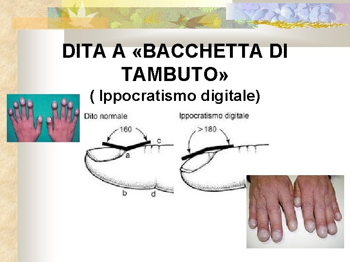 DITA A «BACCHETTA DI TAMBUTO» ( Ippocratismo digitale) 