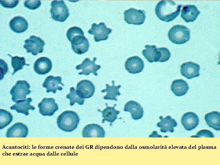 Acantociti: le forme crenate dei GR dipendono dalla osmolarità elevata del plasma che estrae