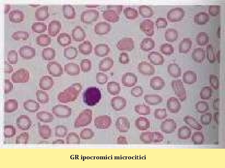 GR ipocromici microcitici 