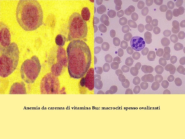 Anemia da carenza di vitamina B 12: macrociti spesso ovalizzati 