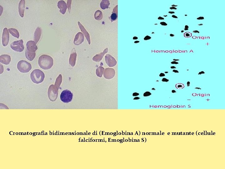 Cromatografia bidimensionale di (Emoglobina A) normale e mutante (cellule falciformi, Emoglobina S) 
