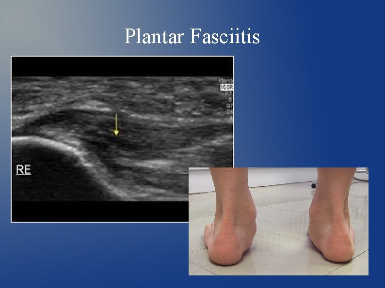 Plantar Fasciitis 