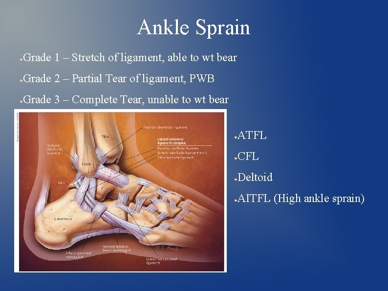 Ankle Sprain ● Grade 1 – Stretch of ligament, able to wt bear ●