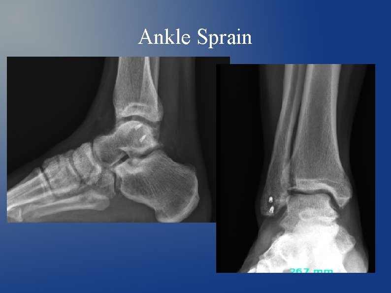 Ankle Sprain 