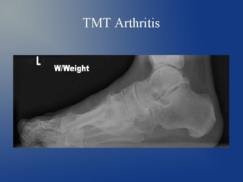 TMT Arthritis 