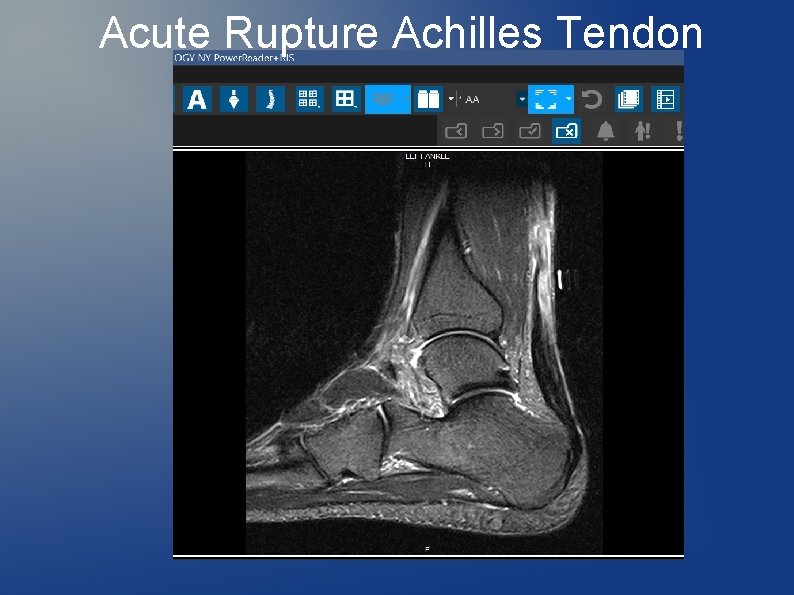 Acute Rupture Achilles Tendon 
