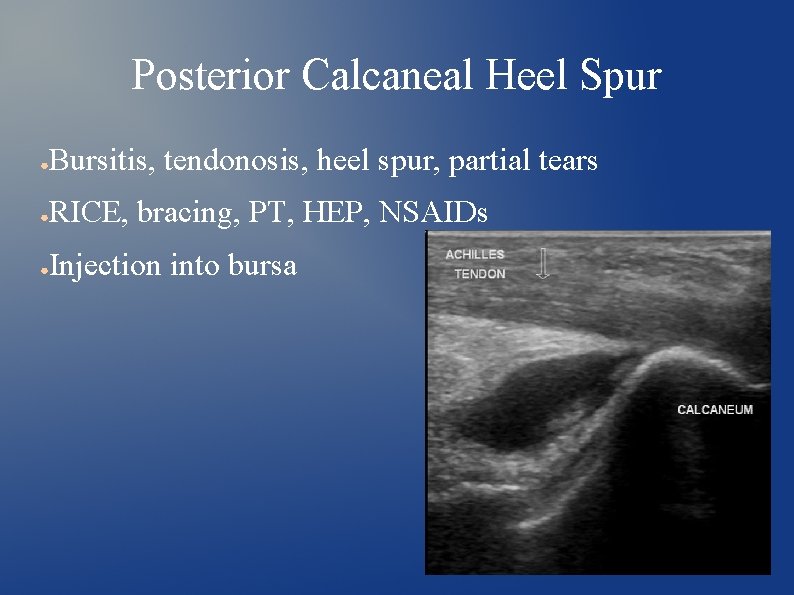 Posterior Calcaneal Heel Spur ● Bursitis, tendonosis, heel spur, partial tears ● RICE, bracing,