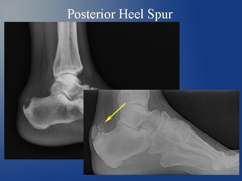 Posterior Heel Spur 
