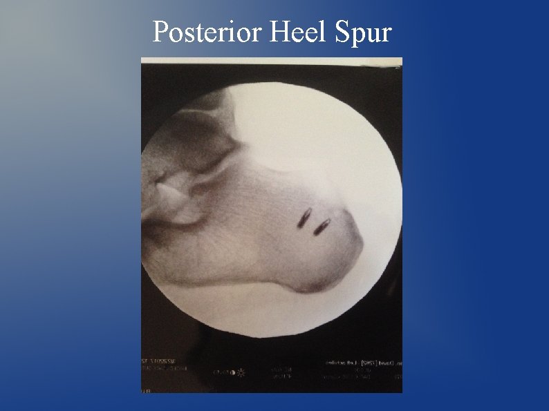 Posterior Heel Spur 