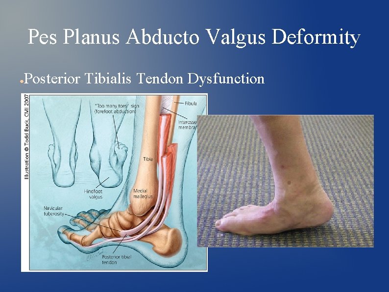 Pes Planus Abducto Valgus Deformity ● Posterior Tibialis Tendon Dysfunction 