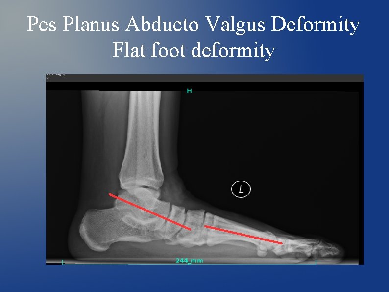 Pes Planus Abducto Valgus Deformity Flat foot deformity 