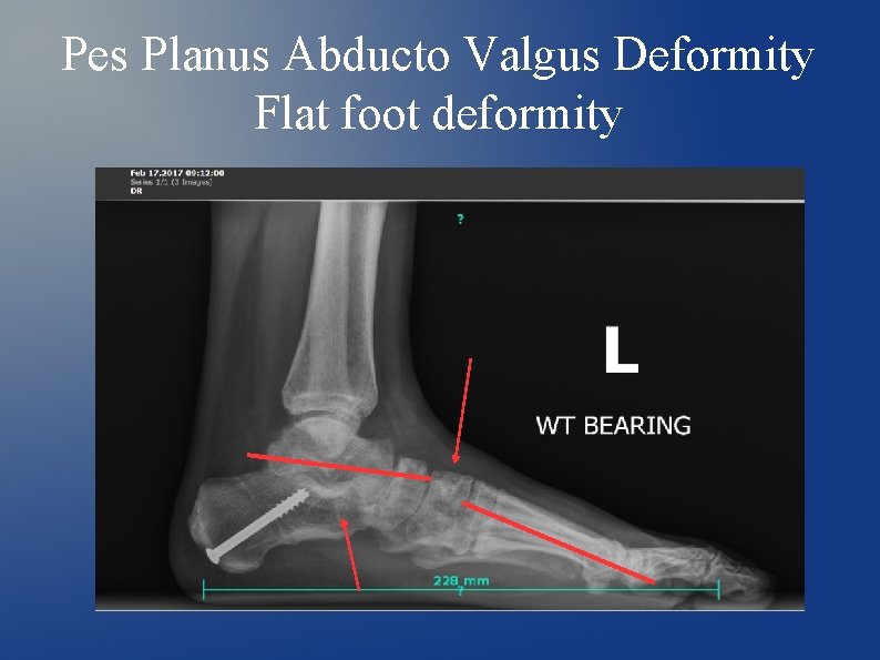 Pes Planus Abducto Valgus Deformity Flat foot deformity 