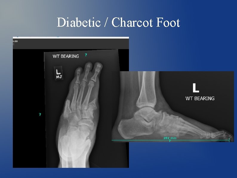 Diabetic / Charcot Foot 