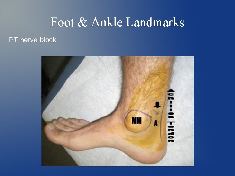 Foot & Ankle Landmarks PT nerve block 