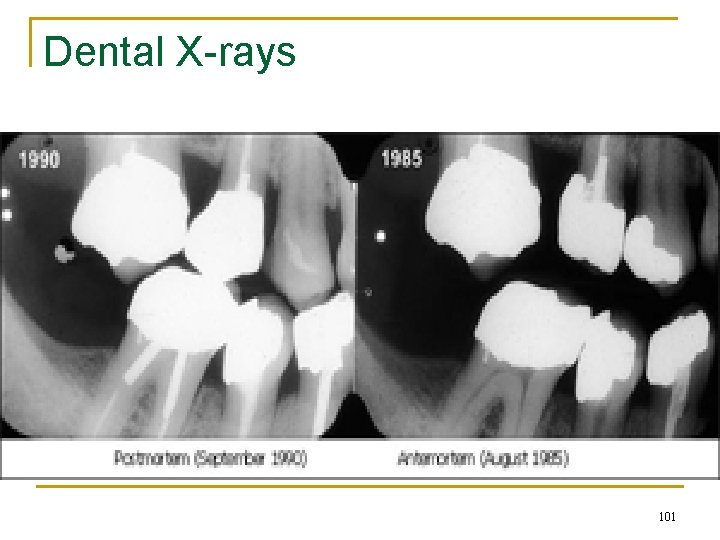 Dental X-rays 101 