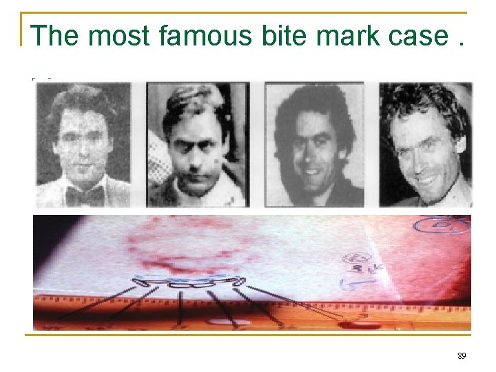 The most famous bite mark case. . . 89 