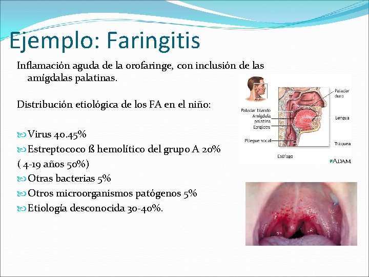Ejemplo: Faringitis Inflamación aguda de la orofaringe, con inclusión de las amígdalas palatinas. Distribución