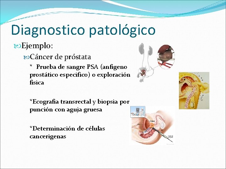 Diagnostico patológico Ejemplo: Cáncer de próstata * Prueba de sangre PSA (anfígeno prostático especifico)